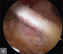 avulsed ACL