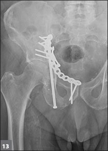 Postop AP pevlvis radiograph