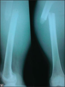  radiograph of the patient’s left femur