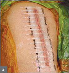after the straps of the closure device were tightened