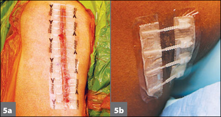 The final appearance of the closure device