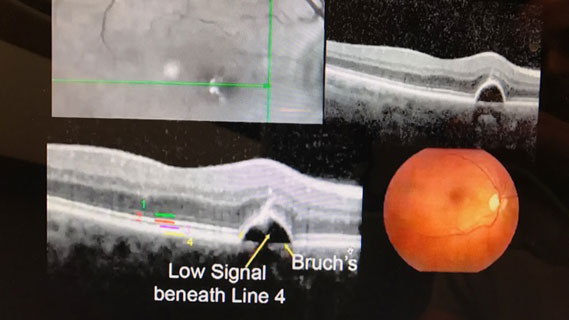 Central serous retinopathy