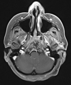 Figure 2: Postcontrast axial golden-angle radial sparse parallel (GRASP) shows a heterogeneously enhancing endophytic nasopharynx mass eroding the clivus with intracranial extension.