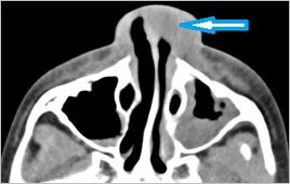 Nasal abscess.