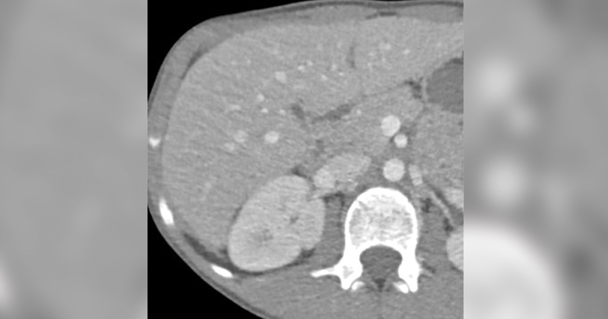 Figure 2. A follow-up CT revealing resolution of the lesions in the liver.