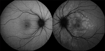 Fundus autofluorescence photography