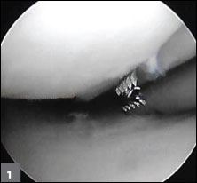 A tight medial compartment