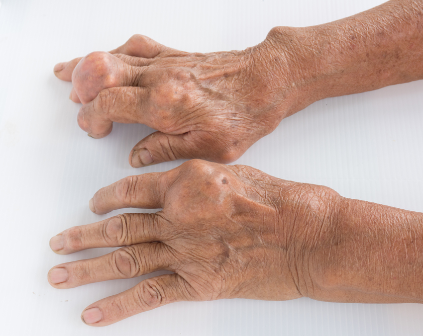 Gout linked to increased risk for erectile dysfunction