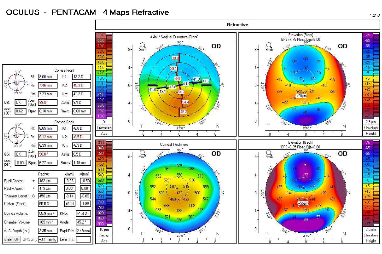 This patient’s right eye after cross-linking. Source: Katie Greiner, OD, MS, MBA, FAAO